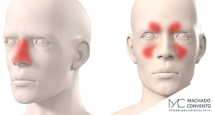 Diferença entre rinite e sinusite: O que você precisa saber